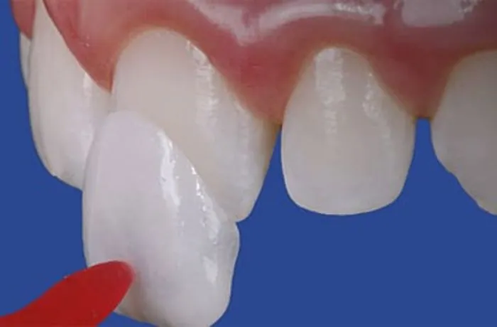 Ilustración de la colocación de una carilla dental